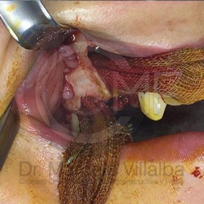 Comunicacion Seno Maxilar 3