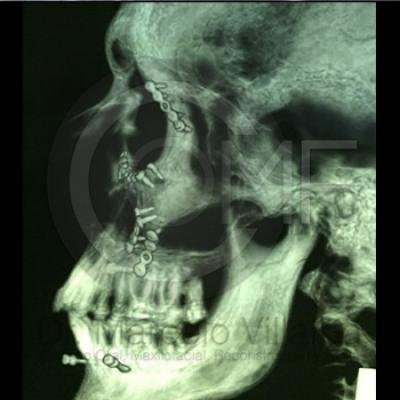Fractura De Malar16 Post