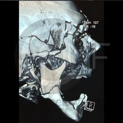 Fractura Facial3