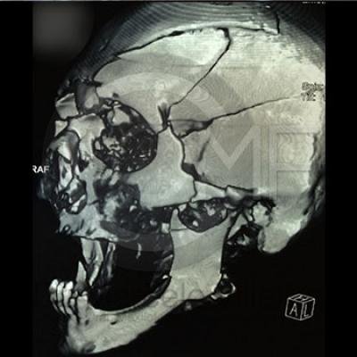 Fractura Facial4