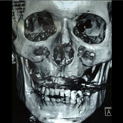 Fractura Lefort I 2