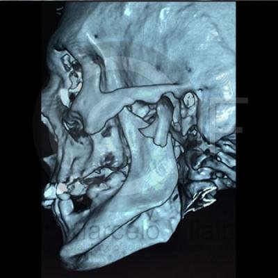 Fractura Mandibular01