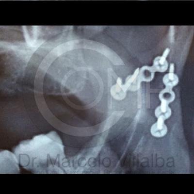 Fractura Mandibular02