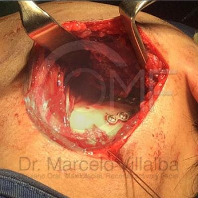 Fractura Mandibular04