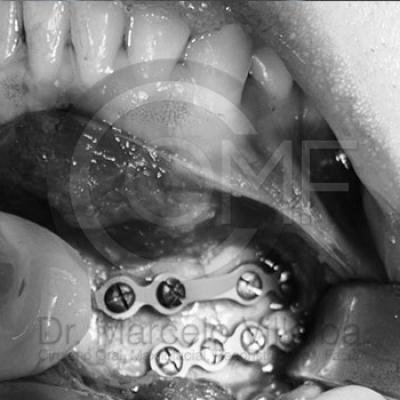 Fractura Mandibular05