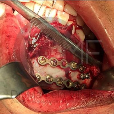 Fractura Mandibular9