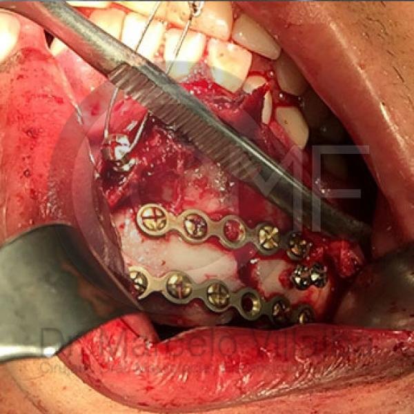 Fractura Mandibular